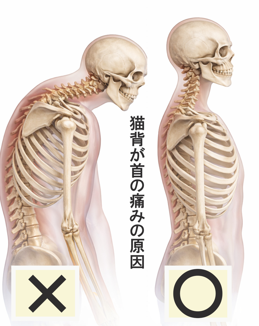 猫背と上を向いたときの首の負担